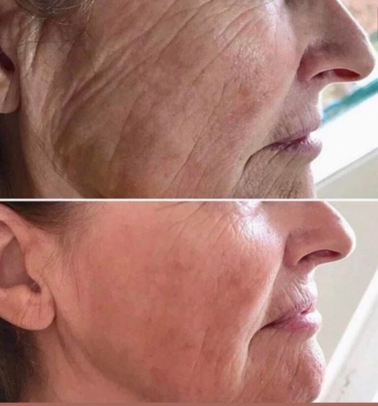 Profhilo Before And After Photos Australia Bio Remodelling Filler