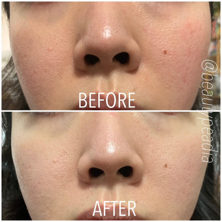 Before and after Profhilo injection points