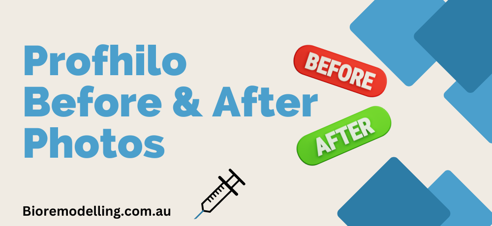 Profhilo Before and After Australia