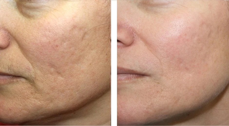 Profhilo acne scars before and after