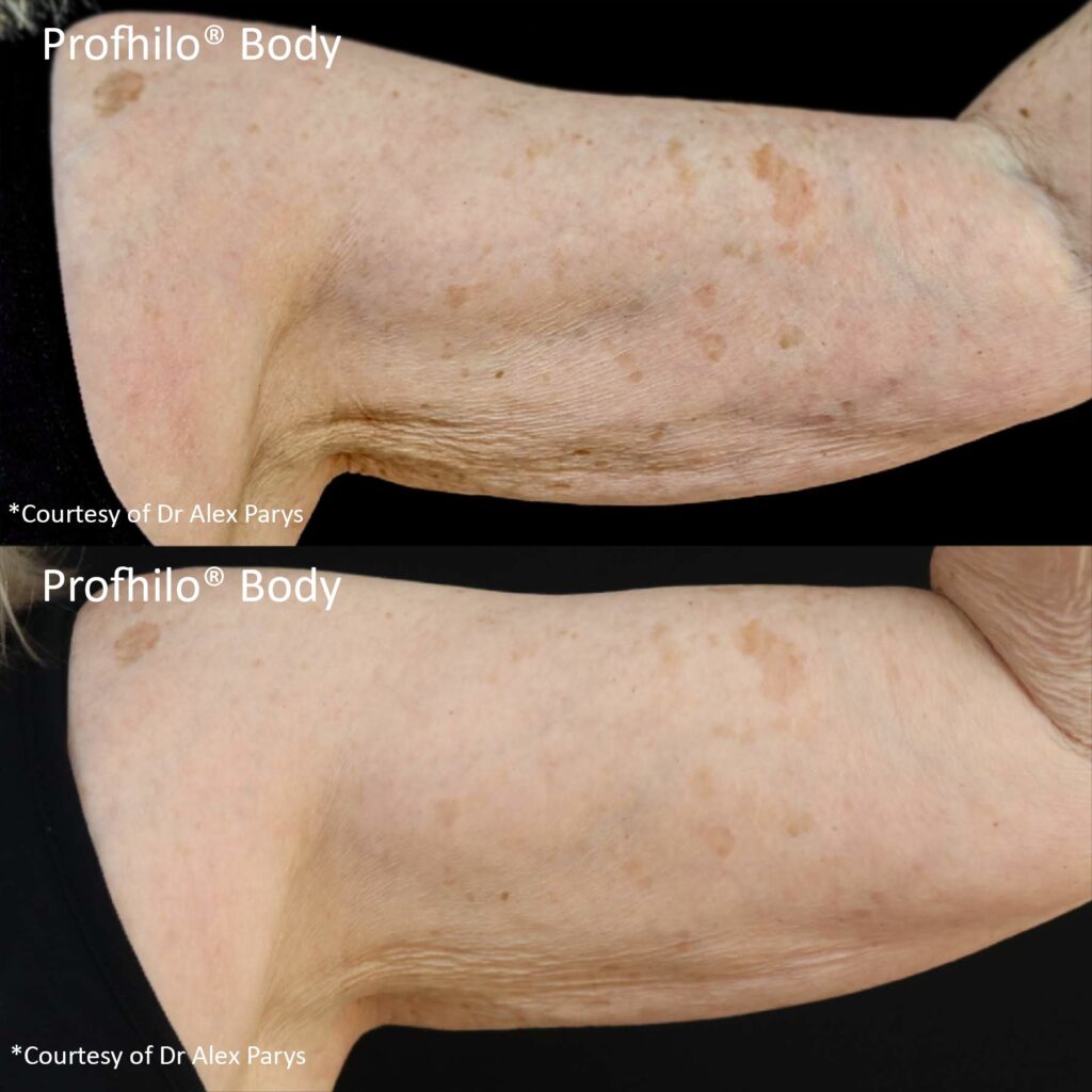 Profhilo arms before and after