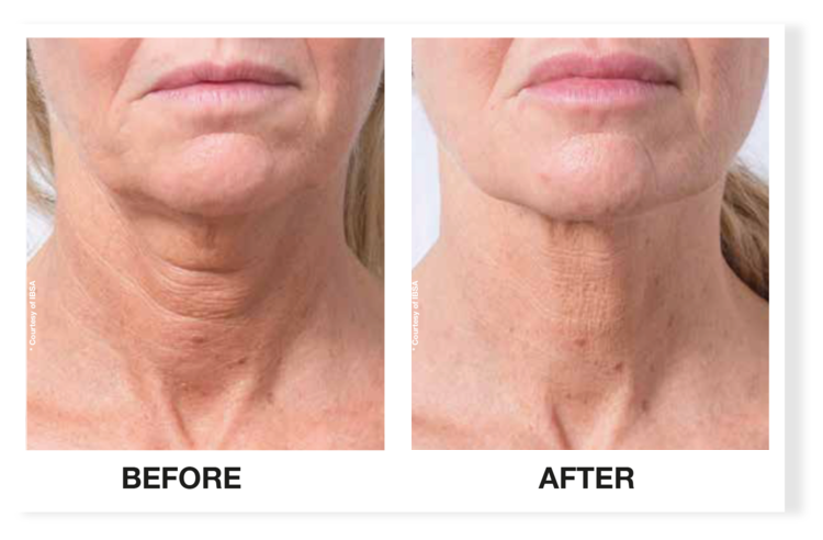 Profhilo for neck before and after