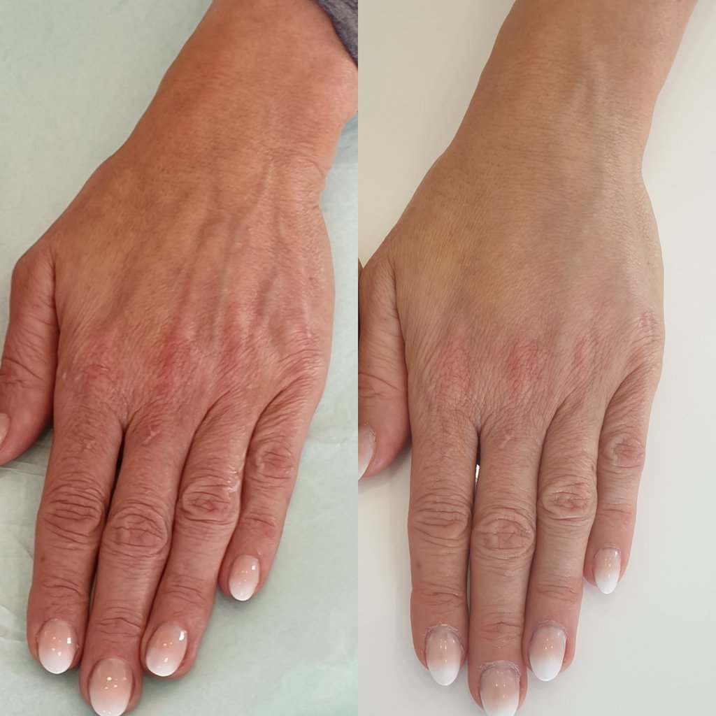 Profhilo hands before and after