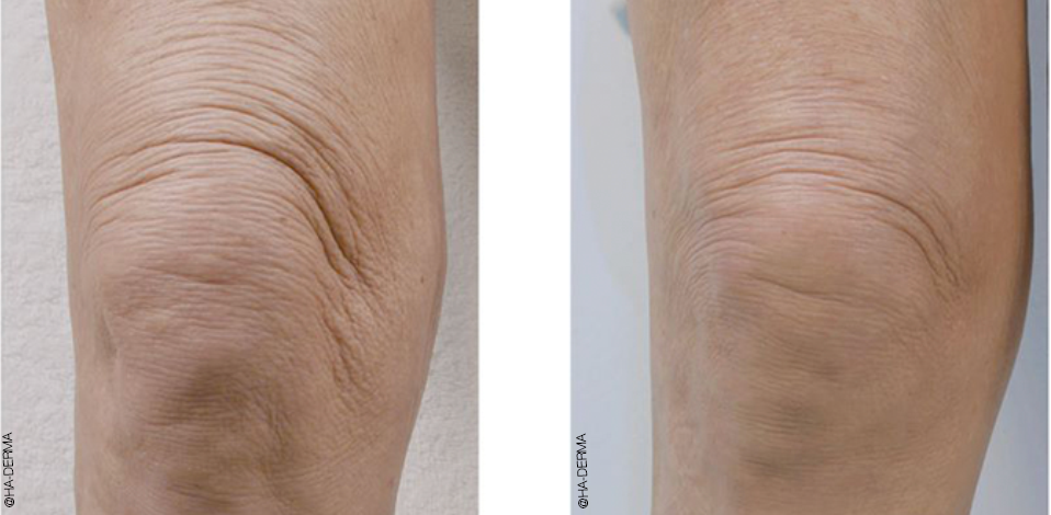 Profhilo knees before and after