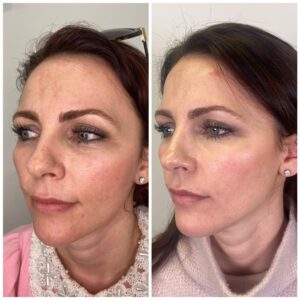 Profhilo Before And After Photos Australia | Bio Remodelling Filler