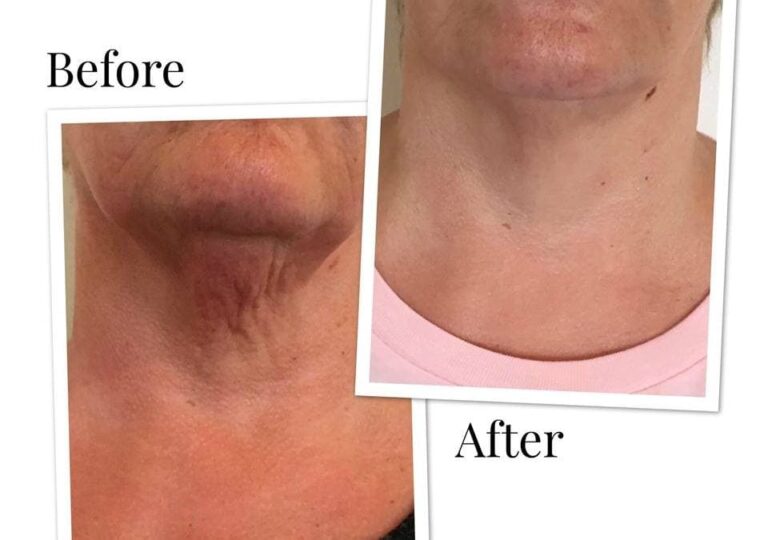 Profhilo Before And After Photos Australia | Bio Remodelling Filler