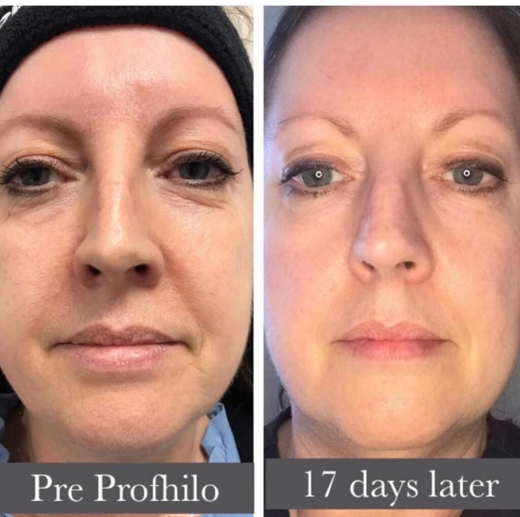 profhilo eyes before and after