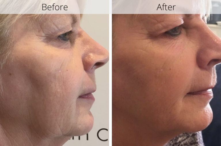 Profhilo Before And After Photos Australia Bio Remodelling Filler 