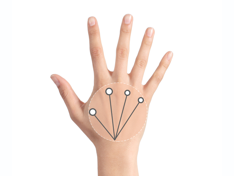 Profhilo Injection Points hands